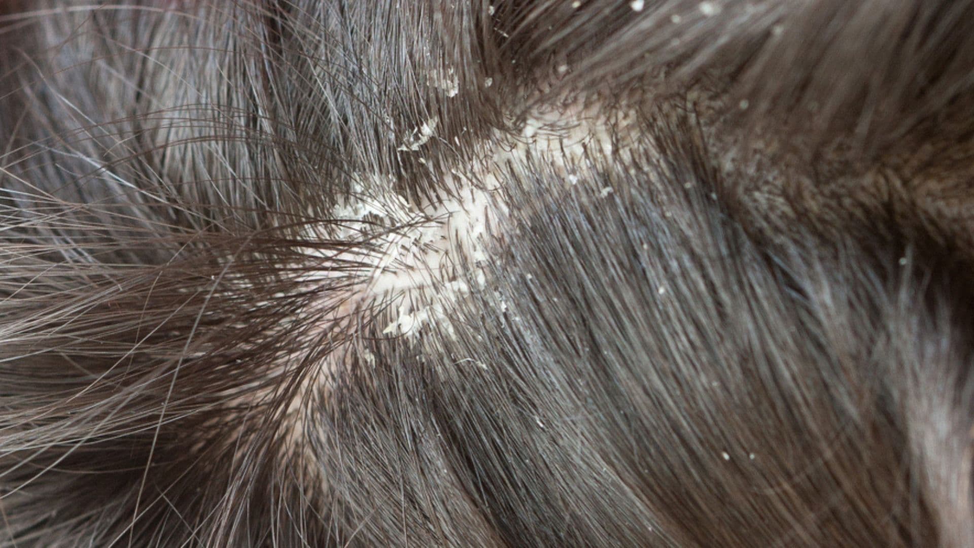 How to care for your scalp.